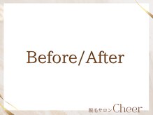 チア(Cheer)/施術例★before⇒after