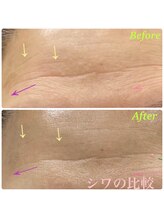 ラボーテ(La Beaute)/しわ＆たるみケア