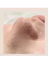 キッキー(Kicky)/大人気！毛穴ケア/汚れ飛び出す