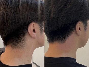 ワクシー 麻布十番店(WAXYYY.)/うなじW脱毛