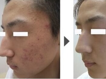 サロンドシュシュ 心斎橋本店(salon de chouchou)/痛々しいお肌のトラブル改善