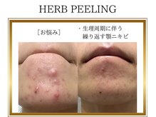 ロージー(ROSY)/ハーブピーリング/阿南/徳島