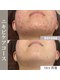 サードプレイス(3rd Place)の写真/もう悩ませない《20代からの大人ニキビ改善なら当店へ》ニキビケア特化の最新ハーブでエステデビュー応援！