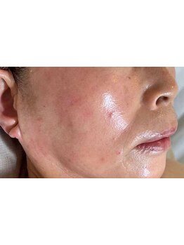 シミしわ改善！予防ケア