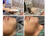 【男性脱毛】青ヒゲ&肌荒れ解消,美肌へ♪ヒゲ全体脱毛+ビタミンC誘導体パック