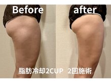 ユー 喜連西店(U)/脂肪冷却【before　after】