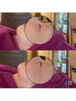 アマリージョヒラソル/Lit ヒト幹細胞エステ