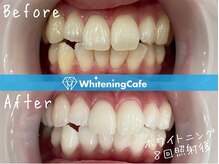 ホワイトニングカフェ 豊中店(WhiteningCafe)/◎歯のホワイトニング施術写真◎