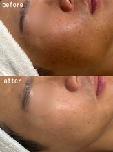 スパ ナナプラス(SPA nana+)/艶肌☆剥離なしピーリング