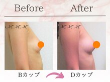 エムエムエム 表参道Luxeサロン(M.M.M)/【バストアップ例】　B→Dカップ