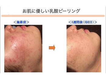 ベッラドンナ(Bella donna)/ニキビケア BeforeAfter