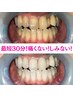 【黄ばみ/歯茎の痩せ】セルフホワイトニング(歯磨き込) 初回お試し ¥2,750