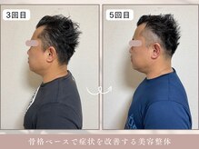 ほぐし屋 かすがい/3、5回目/猫背巻き肩矯正