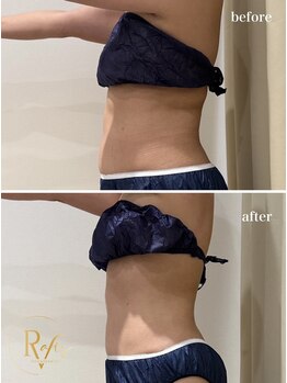 ラヴィス(ravis)/1回でしっかり変化!