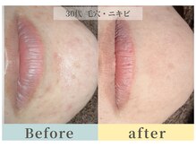 ムク(Muqu.)/生理前に必ずできてたニキビが！