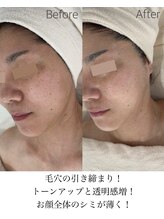 コアラッシュ 福井フェニックス通り店(COA LASH)/シミケアに特化！