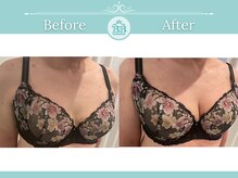 美人バスト 新宿店/☆バストアップ症例写真☆