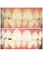 セルフ脱毛サロン　SELFMADE イオンタウン仙台泉大沢店【3/29 NEW OPEN（予定）】 /ホワイトニングビフォーアフター