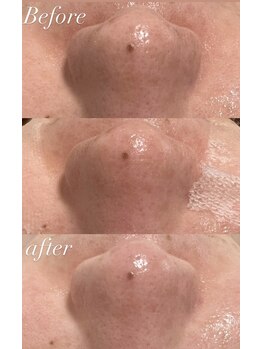 ヨルエステ(yoru aesthe)/【毛穴洗浄】