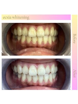 エクシアホワイトニング 草津店/ホワイトニングビフォーアフター