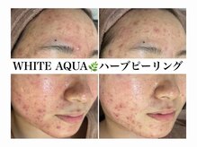 ホワイトアクア 加古川店(WHITE AQUA)/ハーブピーリング/毛穴/加古川