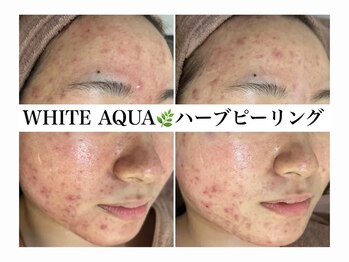 ホワイトアクア 加古川店(WHITE AQUA)/ハーブピーリング/毛穴/加古川
