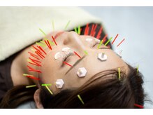 メディカルジャパン 国分寺の雰囲気（美容鍼でお顔スッキリ♪リフトアップ・肌質改善◎）