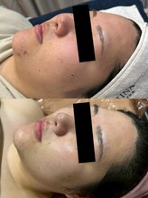 パリスヒロトン(PARIS HIROTON)/オプティル×ハーブピーリング