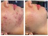 【赤みがあるニキビケアを更に肌奥から】アクネ菌抑制+無農薬ハーブ作用