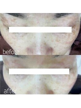 ブランシェ 金沢店 × 椿/シミケア　お客様