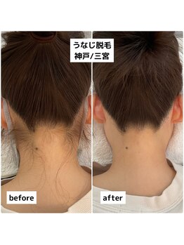 プレヴェール 神戸三宮/うなじ脱毛 襟足(えりあし)脱毛