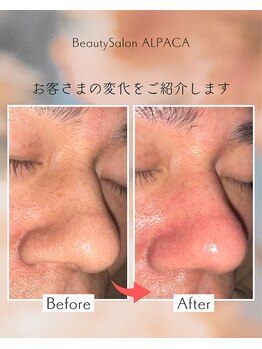 アルパカ(ALPACA)/毛穴の開き・黒ずみのお悩み