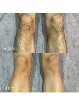 エリクサー 熊谷店(Elixir)/メンズ足脱毛