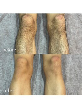 エリクサー 熊谷店(Elixir)/メンズ足脱毛