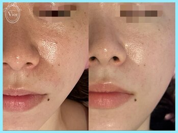 ハーブピーリング 名古屋/TETEピールでワントーンup！