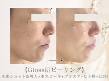 アネラボーテ(Anela Beaute)/Gloss肌ピーリング　艶玉リフト