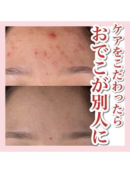 アルムダアクア 天王寺店(Aleumda AQUA)/ハーブピーリング/大阪/天王寺