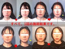 アトラスの雰囲気（顔の左右差を整えるには、“姿勢”がカギになります。）