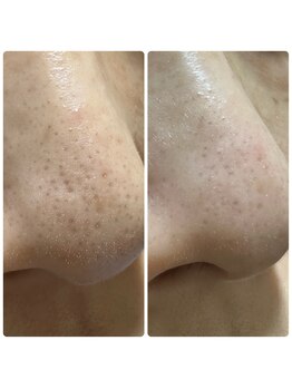 エムリシェ(M.riche)/毛穴洗浄ハイドロフェイシャル