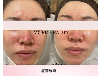 モアビューティー 庚午店(MORE BEAUTY)/★症例写真★赤みケア/詰まり