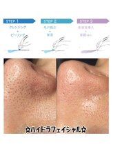 フルール(Fleur)/◆毛穴/ハイドラフェイシャル◆