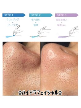 フルール(Fleur)/◆毛穴/ハイドラフェイシャル◆