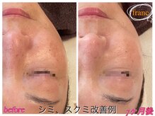 フラン(franc)の雰囲気（毛穴の開きやシワもしっかりアプローチ☆）