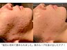 【お悩み別★ニキビ悩み】あなただけの改善プランをご提案¥6000～¥20000