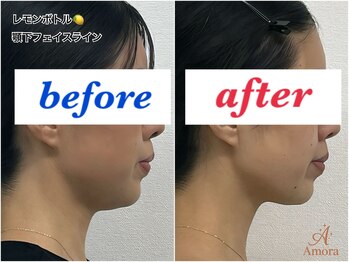 アモーラ(Amora)/レモンボトル顎下