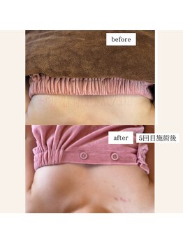 エミニナル(EMININAL)/30代バストアップ(5回目)