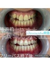 ホワイトニングサロン 名古屋 栄店/【ホワイトニング】