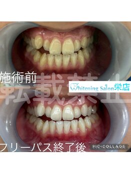 ホワイトニングサロン 名古屋 栄店/【ホワイトニング】