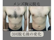 グロワール(gloire)/メンズ胸元脱毛BeforeAfter