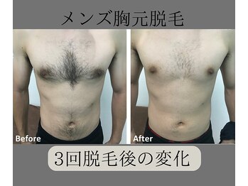 グロワール(gloire)/メンズ胸元脱毛BeforeAfter